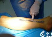 應(yīng)用MIPPO技術(shù)為骨科患者帶來福音?。ㄐぼ姡?></a>
            <div   id=