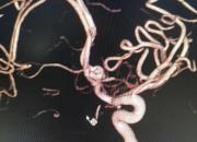 凌源市中心醫(yī)院開(kāi)展全腦血管造影術(shù)，為患者帶來(lái)福音（趙海霞 李蔚藍(lán)）