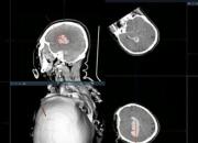 朝陽市中心醫(yī)院順利完成遼西首例機器人引導下腦出血手術(shù)