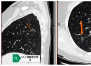 建科十周年獻禮：朝陽四院單孔無管胸腔鏡手術惠及肺結(jié)節(jié)患者（勞海軍 孫冬梅）